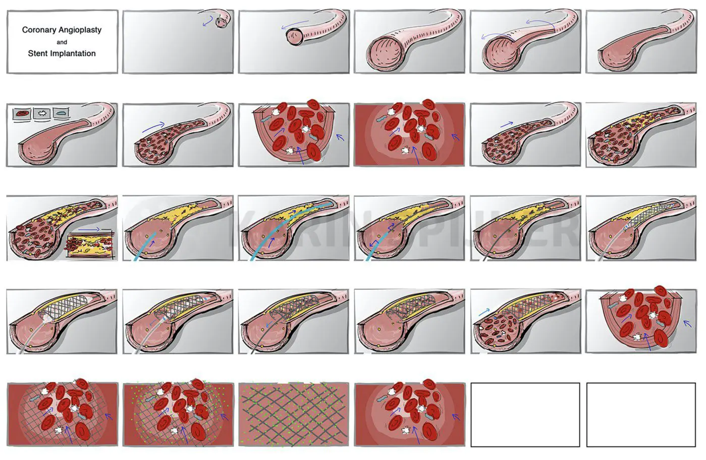 Coronary Angioplasty: Restoring Heart Blood Flow Coronary angioplasty and stent placement diagrams illustrating blood flow restoration in atherosclerosis.