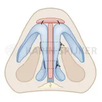 Rhinoplasty