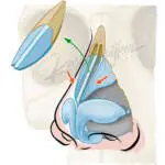 Anatomical illustration of the nasal cavity highlighting inverted V hump and airflow pathways.