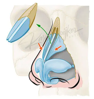 Anatomical illustration of the nasal cavity highlighting inverted V hump and airflow pathways.
