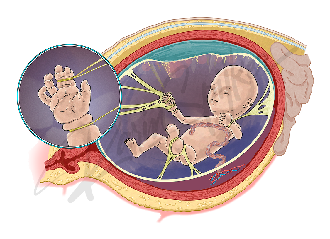 Amniotic Band Syndrome: Understanding the Impact Amniotic band sequence illustration showcasing effects and implications in prenatal development.
