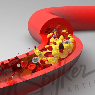 Detailed illustration of atherosclerosis, highlighting artery plaque buildup and cardiovascular health effects.