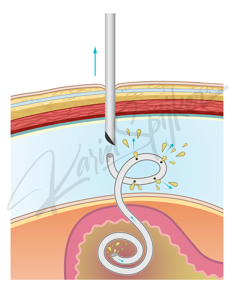 Bladder Decompression Shunt Technology Explained Bladder decompression shunt procedure illustration for improved urinary function and relief.