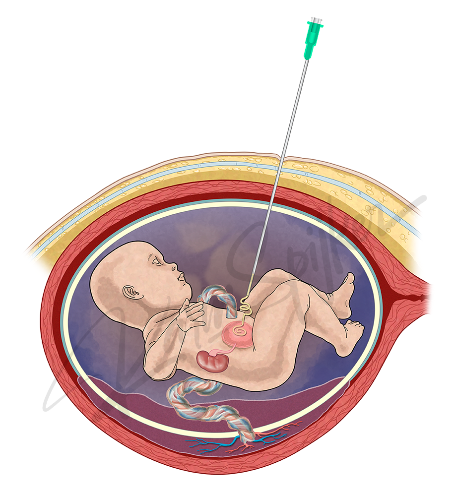 Bladder Decompression Shunt Overview Bladder decompression with a shunt procedure for improved urinary function.