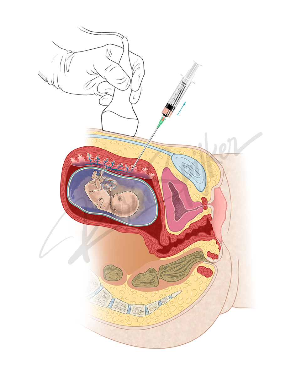 Transabdominal Chorionic Villus Sampling Explained Transabdominal chorionic villus sampling (CVS) procedure image for prenatal genetic testing.