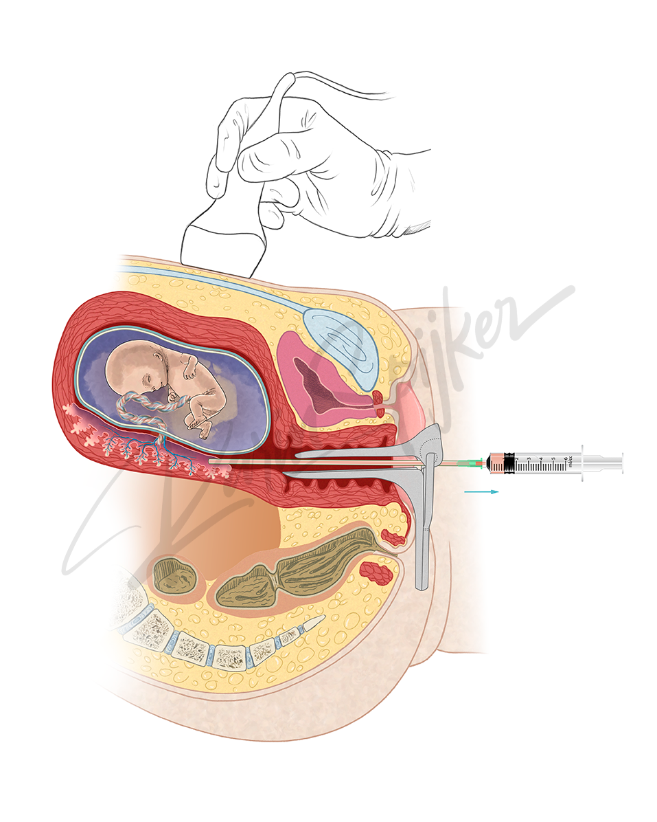 Transcervical Chorionic Villus Sampling Explained Chorionic Villus Sampling (CVS) procedure via transcervical method for prenatal genetic testing.