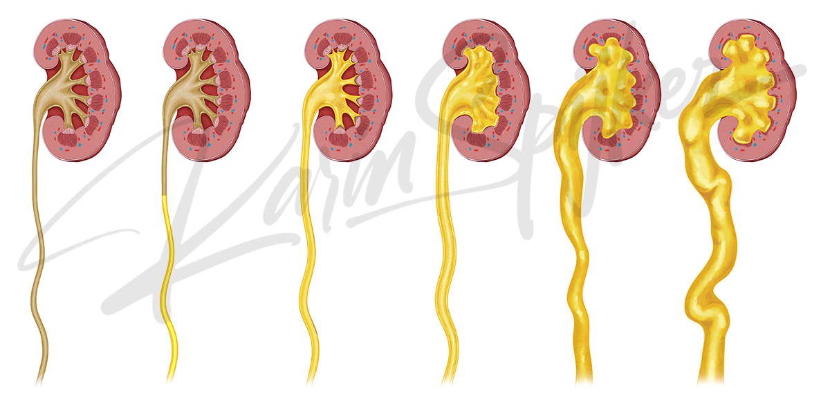 Understanding Congenital Hydronephrosis: Five Grades Explained Five grades of congenital hydronephrosis illustrated for kidney health awareness.