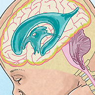 Fetal brain and spinal cord anatomy with hydrocephalus in the amniotic sac.