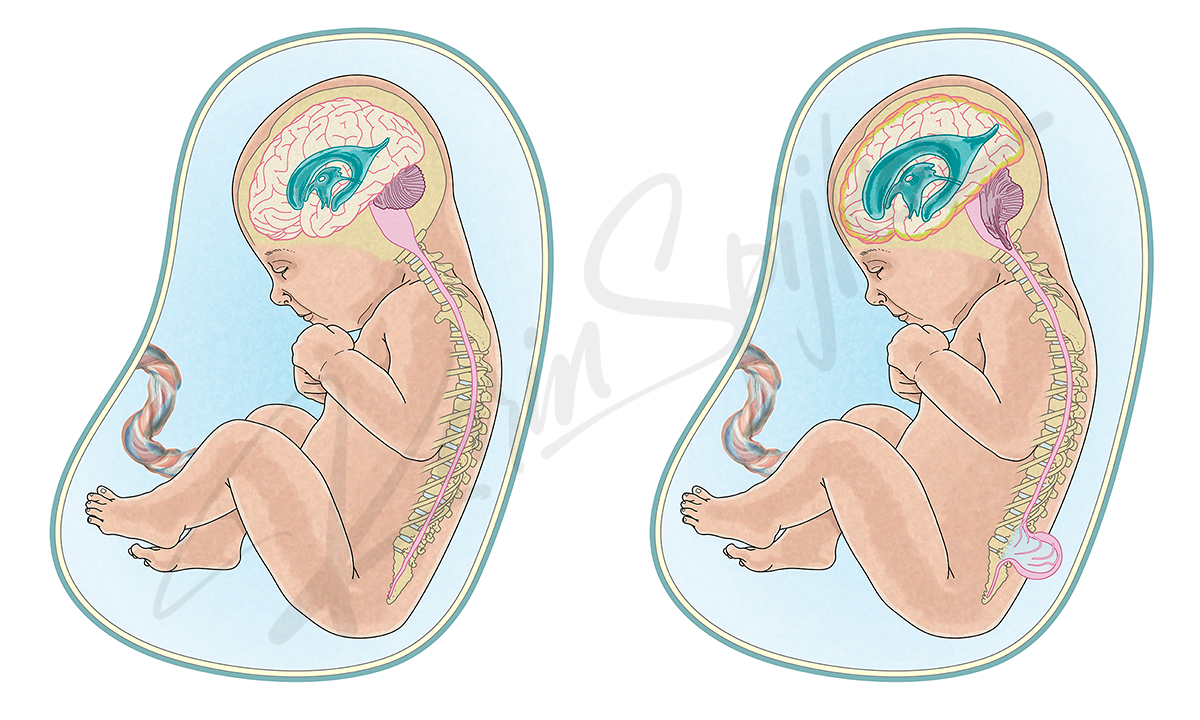 Fetus showing normal brain, spinal cord anatomy, and hydrocephalus in amniotic sac. Fetus showing normal brain, spinal cord anatomy, and hydrocephalus in amniotic sac.