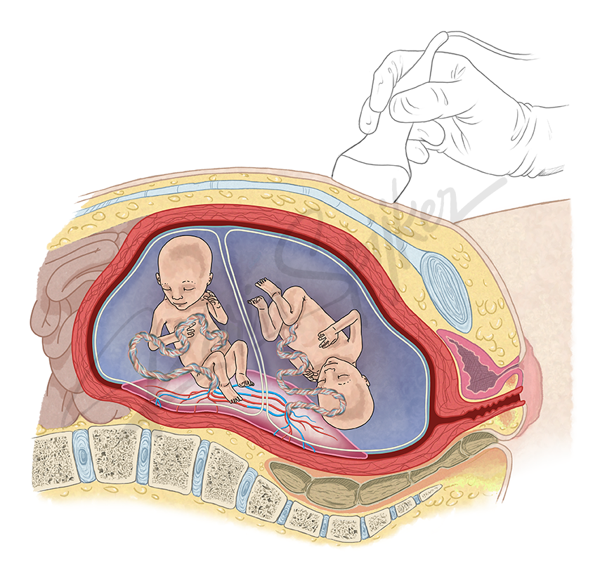 Healthy Twin Pregnancy Healthy twin in pregnancy