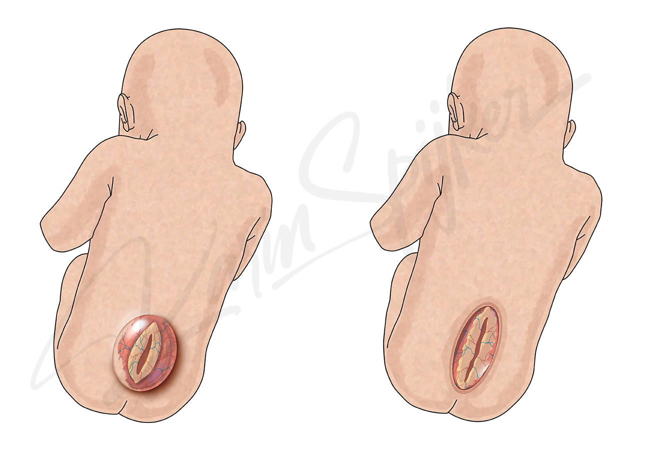 Understanding spina bifidas impact Myelomeningocele in an infant: Understanding spina bifidas impact and care.