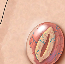 Myelomeningocele in a baby, highlighting condition details and care essentials.