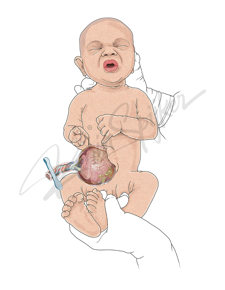 Image of omphalocele condition illustrating abdominal wall defect in newborns. Illustration of omphalocele showing abdominal wall defect in newborns.