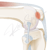 Detailed image of PFPS knee condition for better understanding and awareness.