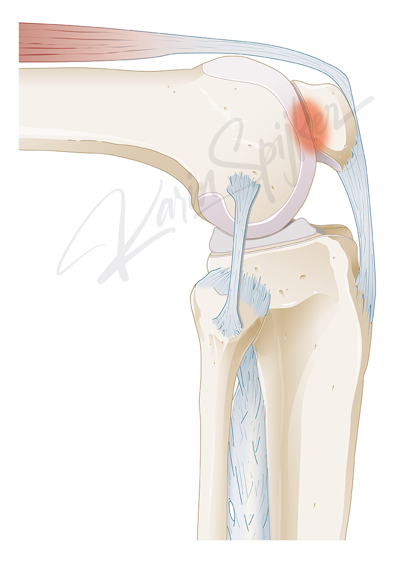 Understanding Patellofemoral Pain Syndrome in the Knee Knee pain relief strategies for Patellofemoral Pain Syndrome (PFPS) illustrated effectively.