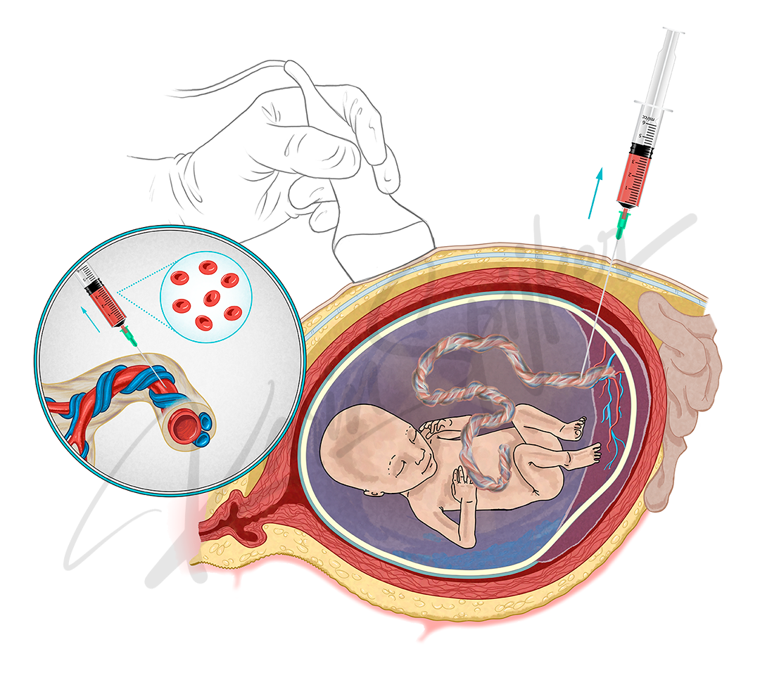 Percutaneous Umbilical Blood Sampling Explained Percutaneous umbilical blood sampling (PUBS) procedure illustrating technique and equipment used.