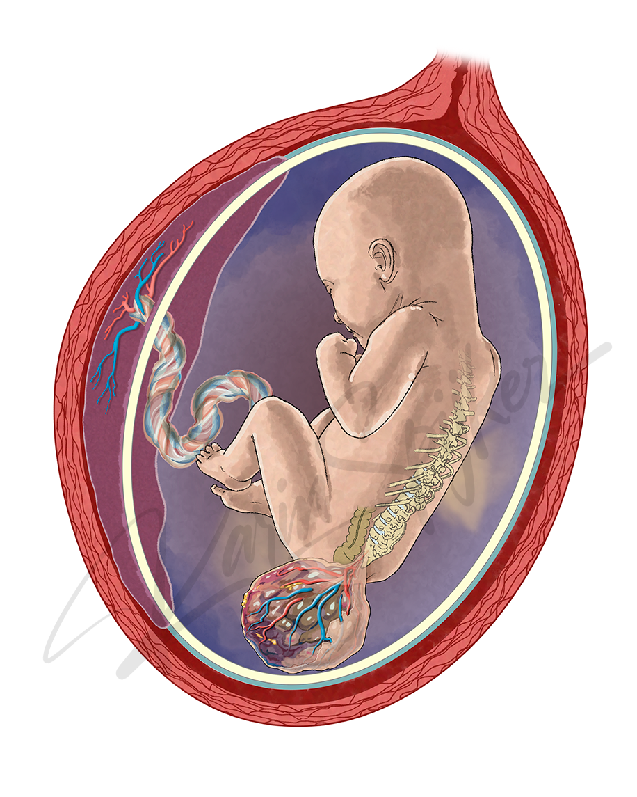 Sacrococcygeal Teratoma in Womb Sacrococcygeal teratoma in foetus within womb, highlighting prenatal tumour development.
