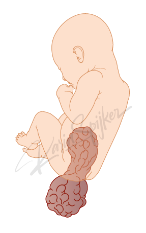 Sacrococcygeal Teratoma Type 2 Overview Sacrococcygeal teratoma type 2 image illustrating tumour characteristics and presentation.