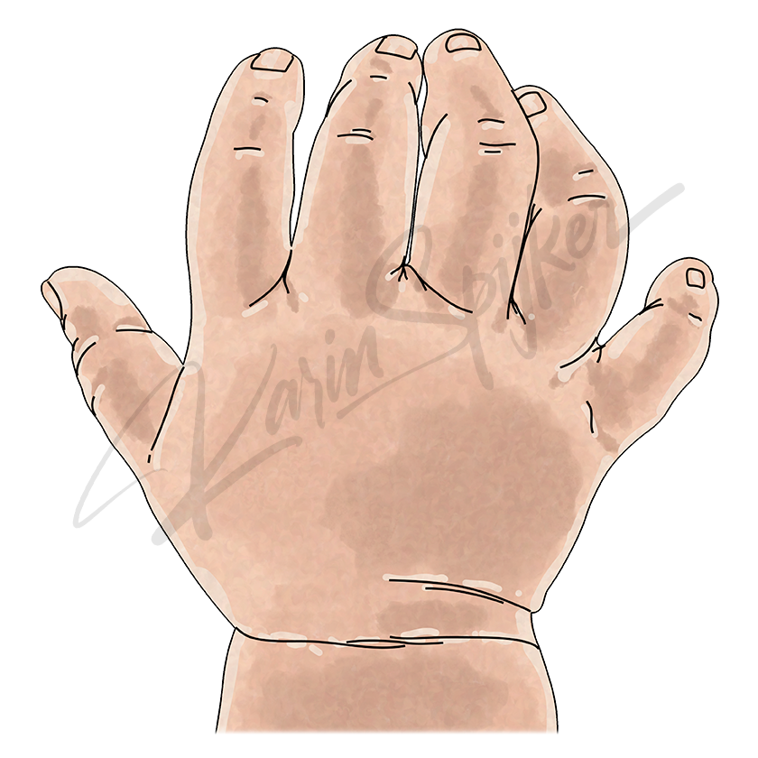 Polydactyly in Trisomy 13: Extra Fingers Explained Hand with extra fingers due to Trisomy 13 (Patau Syndrome) polydactyly condition.