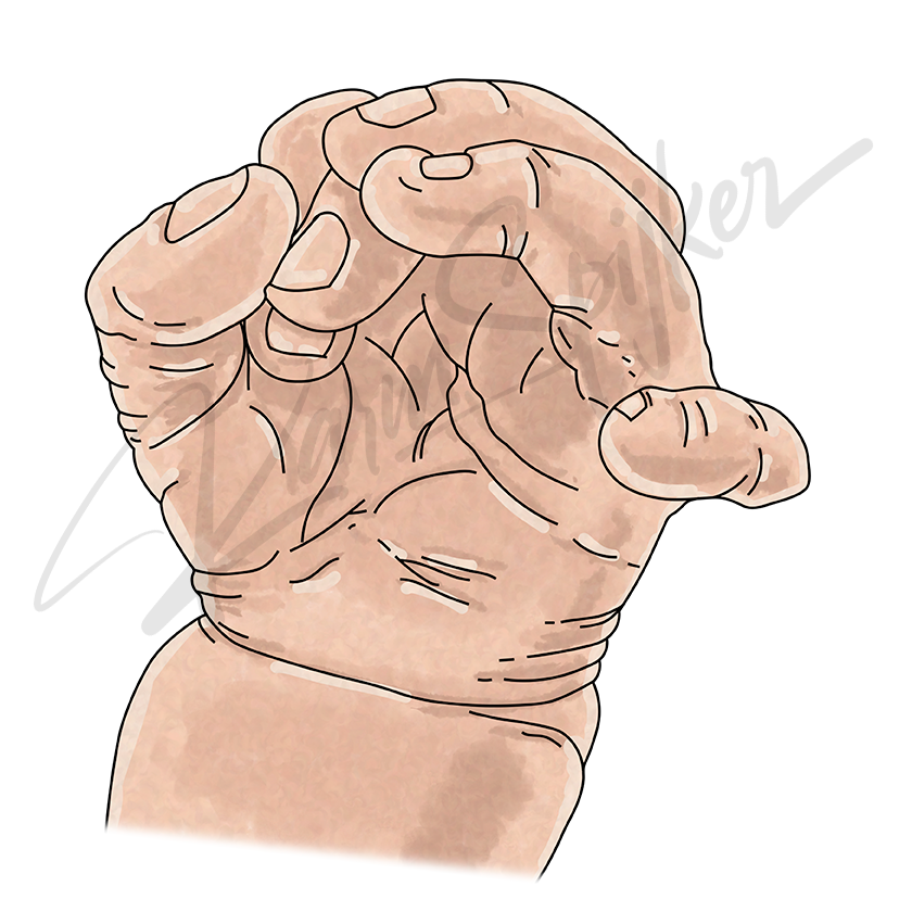 Trisomy 13: Polydactyly and Extra Fingers Explained Hand showing polydactyly, featuring extra fingers related to Trisomy 13 (Patau Syndrome).