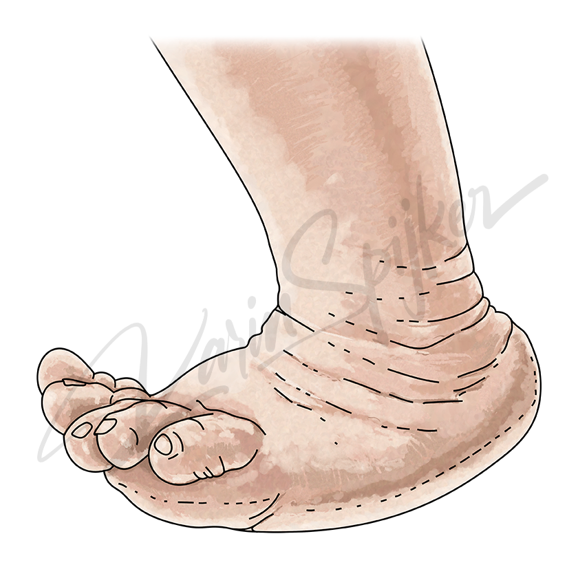 Rocker Bottom Feet in Trisomy 18 (Edwards Syndrome) Rocker bottom feet in Trisomy 18 (Edwards Syndrome) showcase unique physical features.