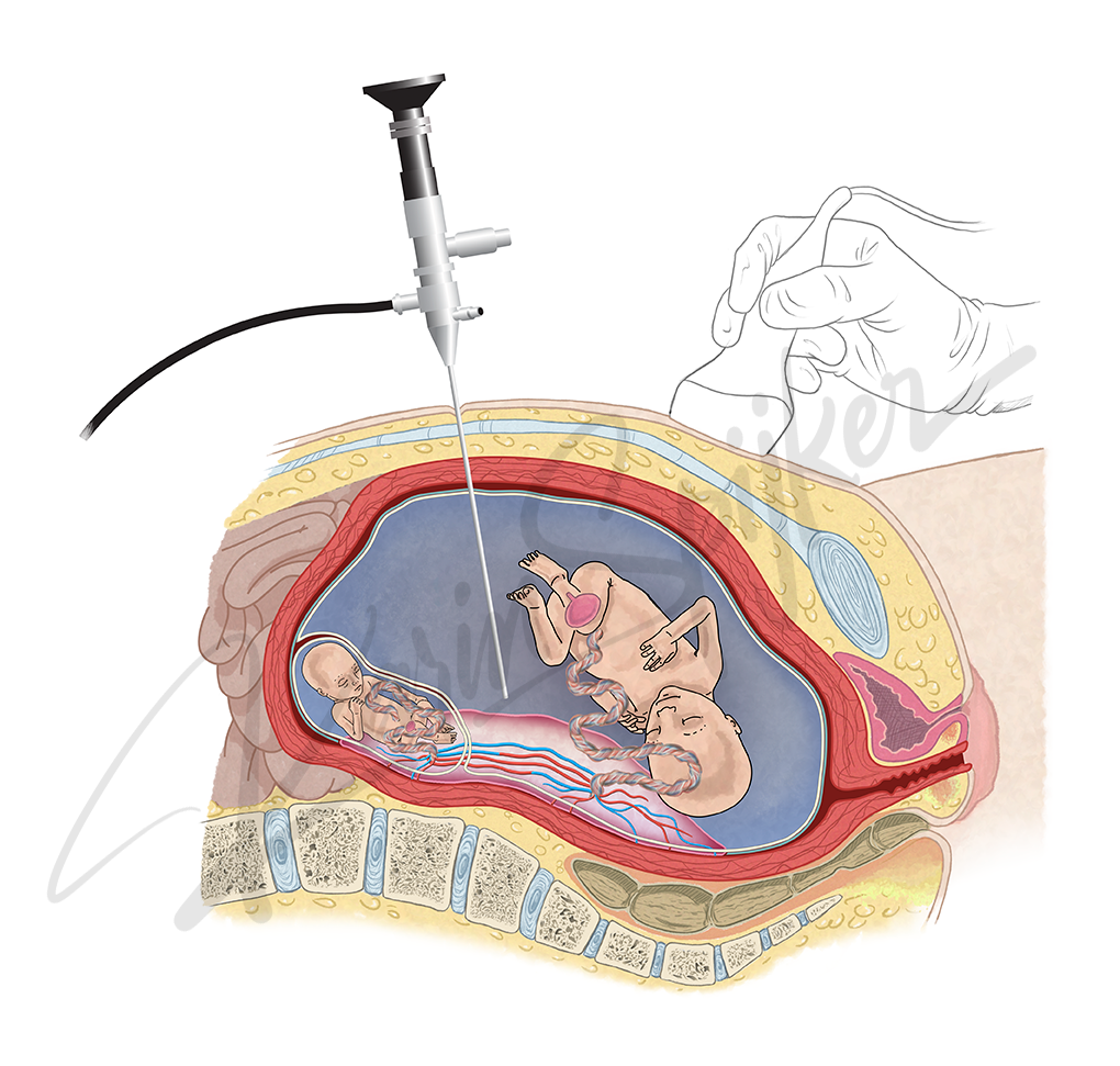 Understanding Twin-To-Twin Transfusion Syndrome Insightful diagram illustrating Twin-To-Twin Transfusion Syndrome in twin pregnancies.
