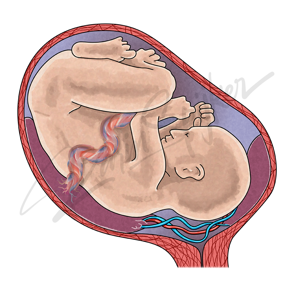 Understanding Vasa Previa: Risks and Management in Pregnancy Vasa previa illustration showing complications and management in pregnancy.