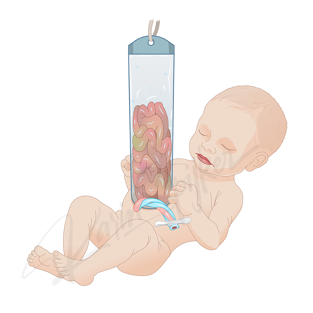 Gastroschisis Repair: A Life-Changing Surgical Journey Gastroschisis repair surgery illustration commissioned by BoomGraphicDesign.